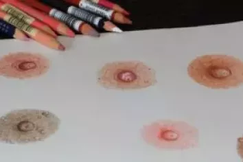 Reconstruction du mamelon et de l'aréole par le tatouage 3D