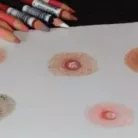 Reconstruction du mamelon et de l'aréole par le tatouage 3D